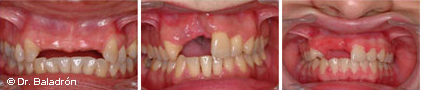 Pacientes que han perdido varios dientes anteriores en el maxilar superior