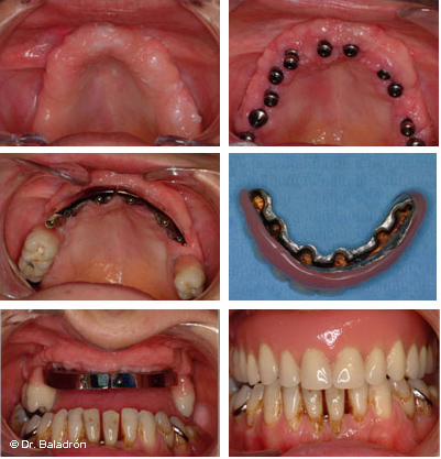 Mandíbula o prótesis dentales, dientes postizos con incisivos