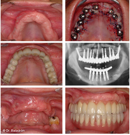Dentaduras completas superiores e inferiores / dientes postizos, a