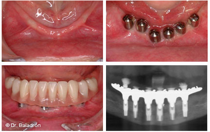 10 dientes sobre 6 implantes