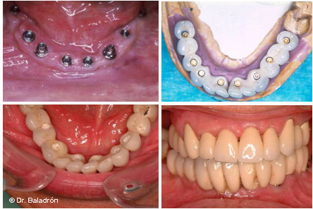Prótesis completa fija mandibular de 12 dientes sobre 8 implantes