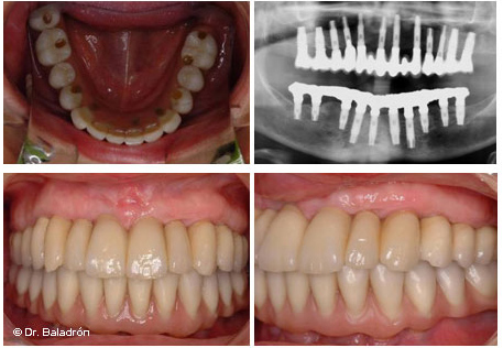 Prótesis completa fija mandibular de 13 dientes sobre 10 implantes
