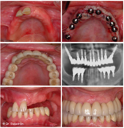 Prótesis completa fija solo con dientes artificiales (12), soportada con 10 implantes