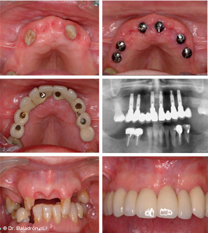 Prótesis completa fija corta solo con dientes artificiales (10), soportada con 6 implantes