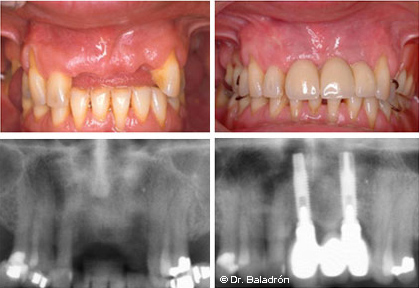 Prótesis parcial fija de 3 dientes sobre 2 implantes colocados en el maxilar superior