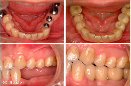 Prótesis parcial fija de 4 dientes sobre 4 implantes colocados en el lado izquierdo de la mandíbula
