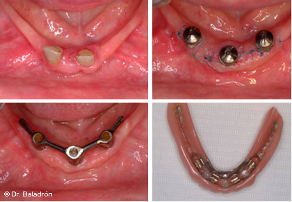 Sobredentadura mandibular sobre 3 implantes unidos con barra